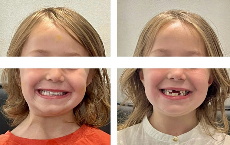 00-Traitement-précoce-fille-de-5ans