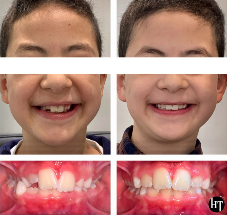 Cas de traitement précoce enfant de 8 ans