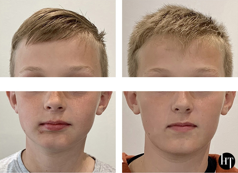 Traitement orthodontique précoce enfant de 9 ans