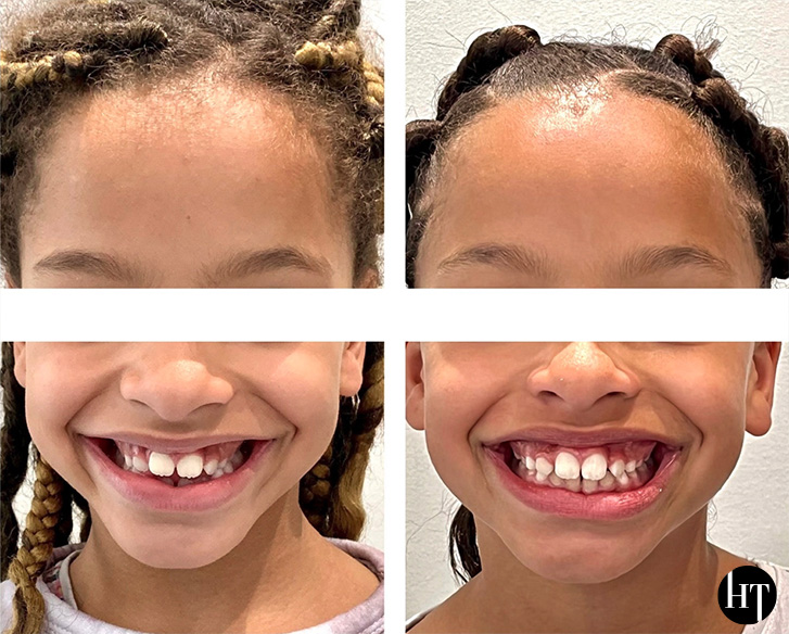Traitement orthodontique précoce enfant de 8 ans