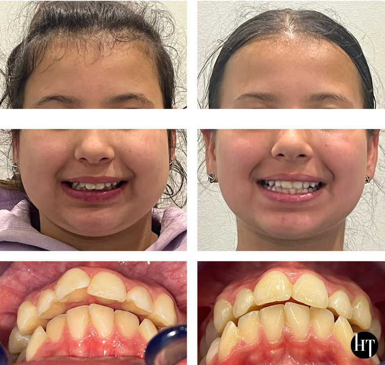 Traitement orthodontique adolescente de 11 ans