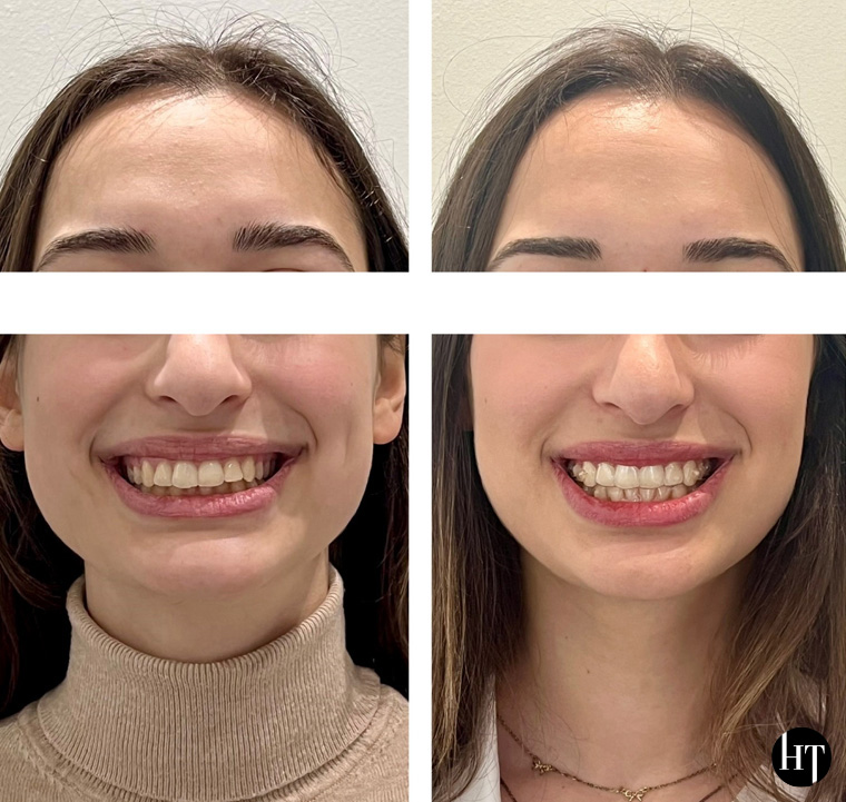 Traitement orthodontique adulte de 20 ans Traitement orthodontique adulte de 20 ans