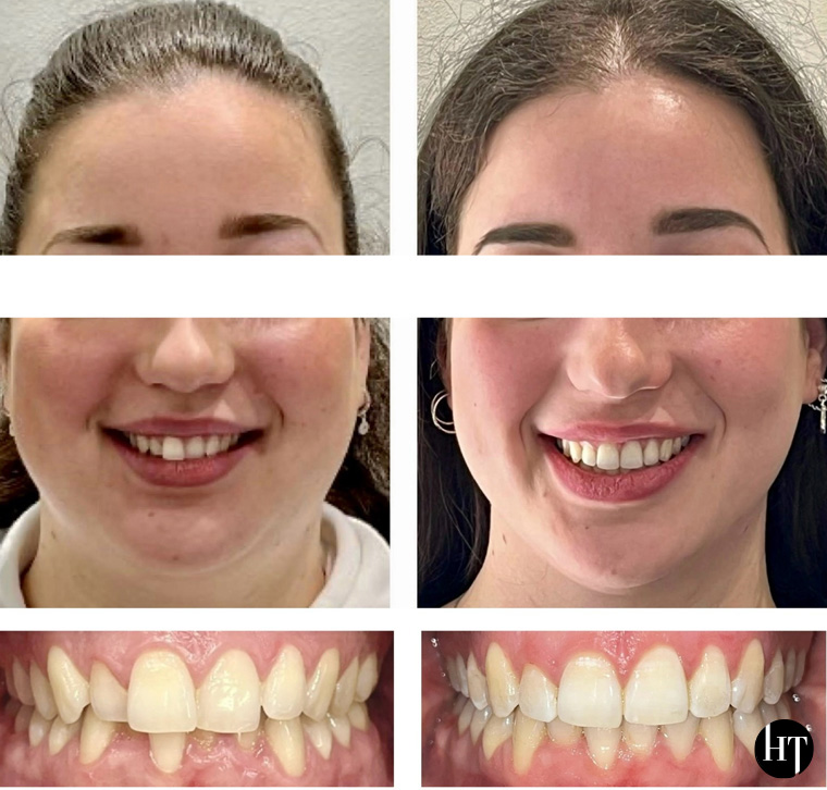 Traitement orthodontique adulte de 27 ans Traitement orthodontique adulte de 27 ans