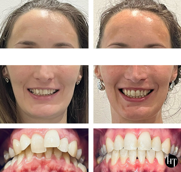 Traitement orthodontique adulte de 31 ans Traitement orthodontique adulte de 31 ans