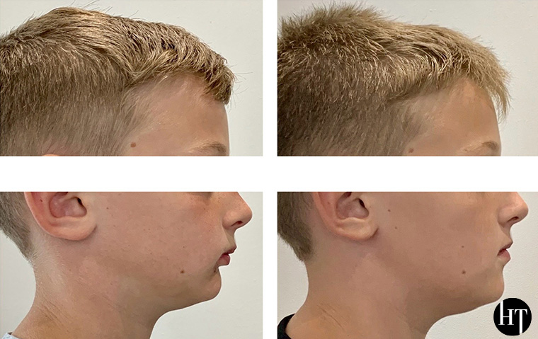 Traitement orthodontique précoce enfant de 9 ans
