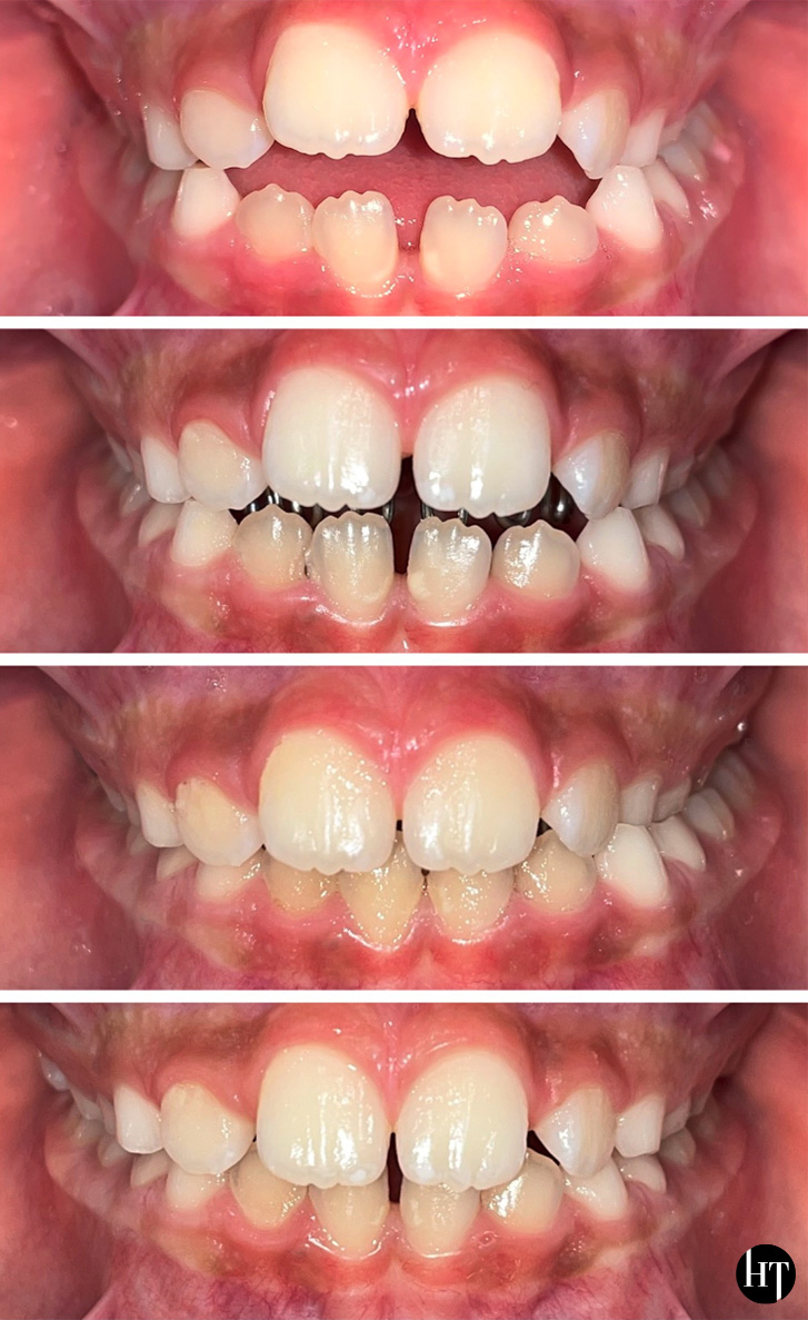 Traitement orthodontique précoce enfant de 8 ans