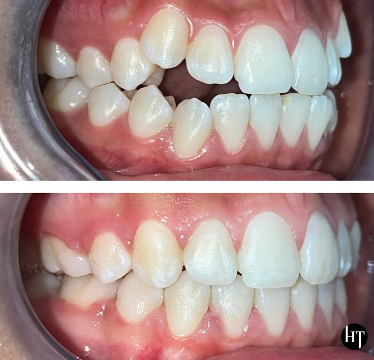 Traitement orthodontique adolescente de 14 ans Traitement orthodontique adolescente de 14 ans