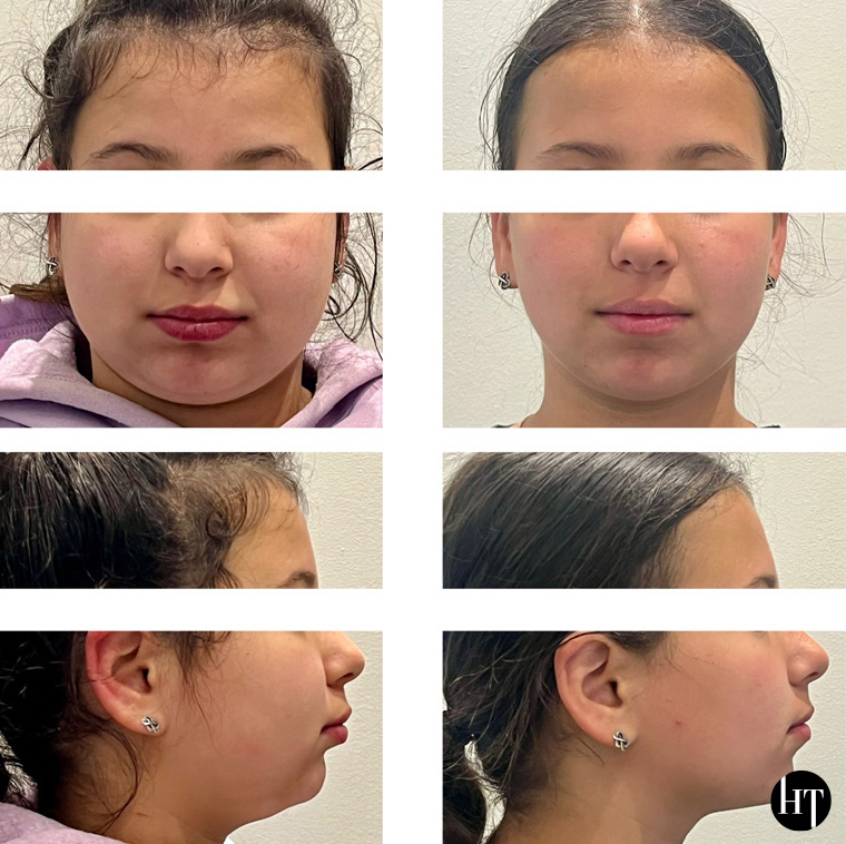 Traitement orthodontique adolescente de 11 ans
