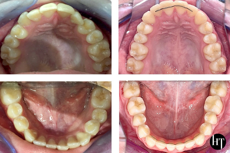 Traitement orthodontique adolescente de 12 ans