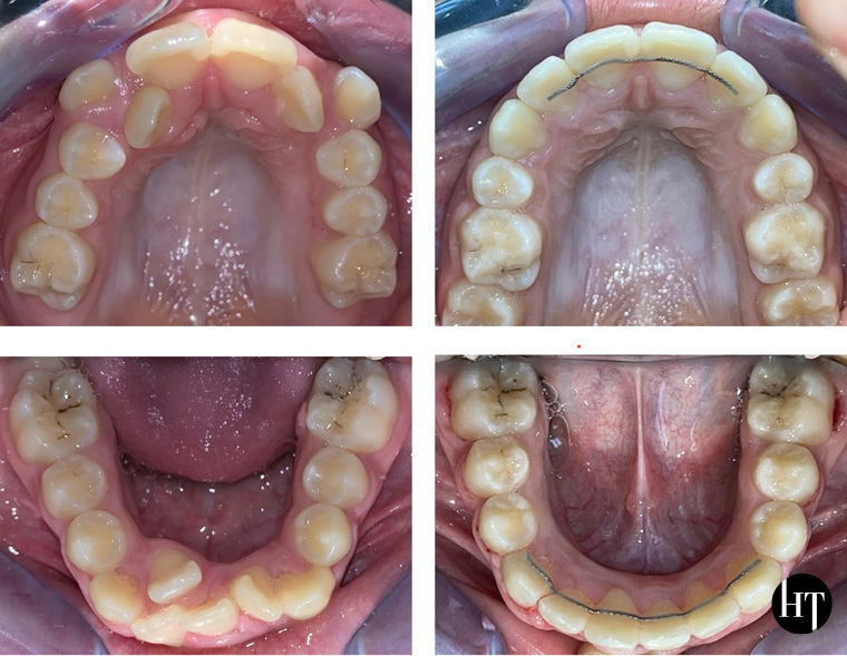 Traitement orthodontique adolescente de 12 ans