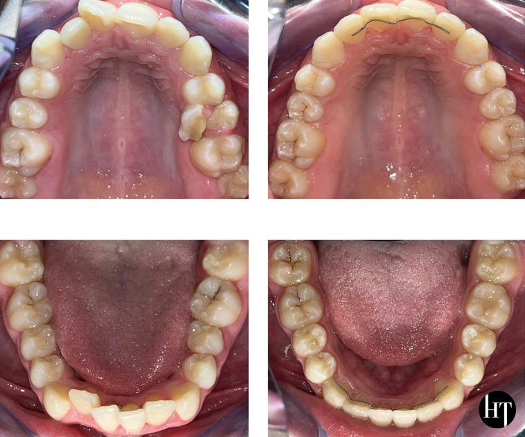 Traitement orthodontique adolescente de 13 ans