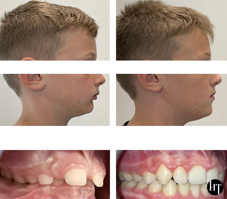 Traitement orthodontique adolescent de 9 ans Traitement orthodontique adolescent de 9 ans