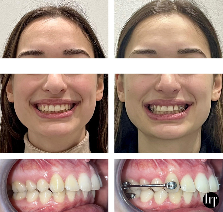 Traitement orthodontique adulte de 20 ans Traitement orthodontique adulte de 20 ans