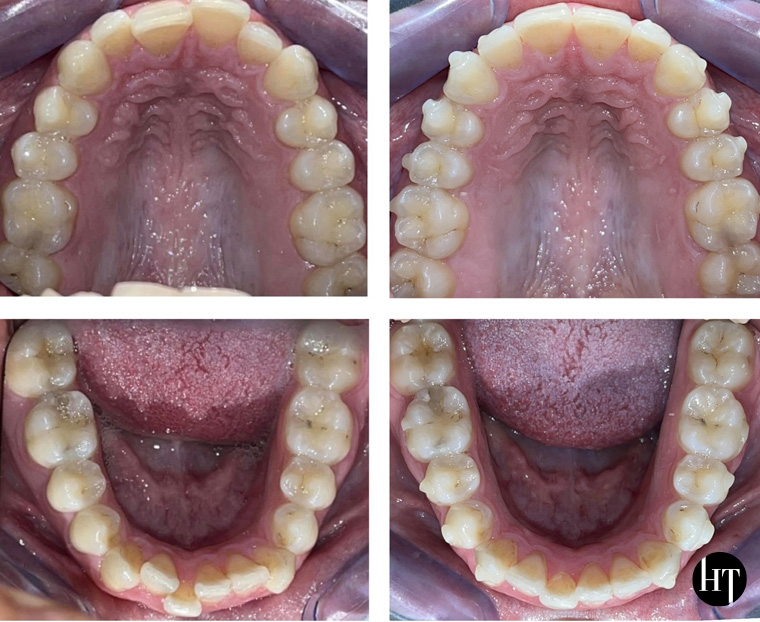 Traitement orthodontique adulte de 27 ans Traitement orthodontique adulte de 27 ans