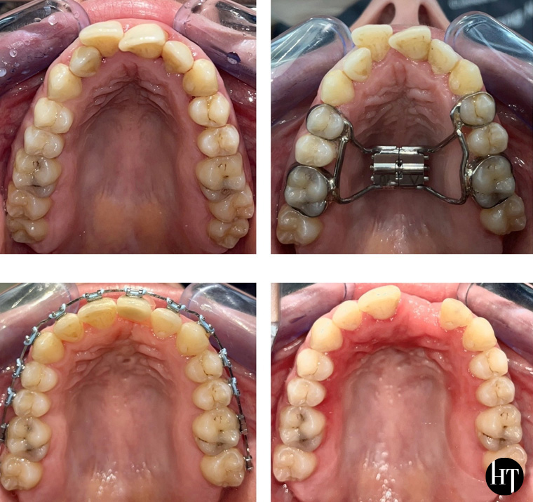 Traitement orthodontique adulte de 28 ans Traitement orthodontique adulte de 28 ans