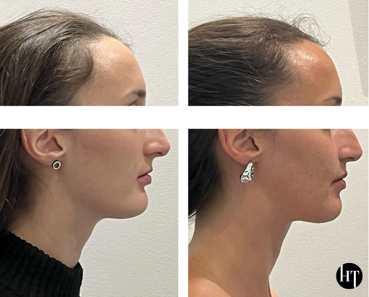 Traitement orthodontique adulte de 31 ans Traitement orthodontique adulte de 31 ans
