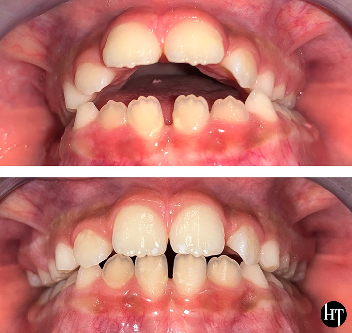 Traitement orthodontique précoce enfant de 8 ans