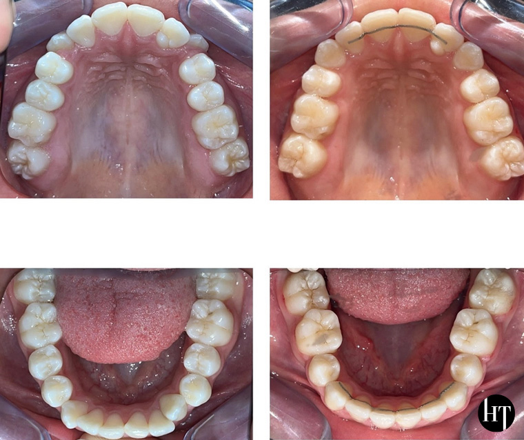 Traitement orthodontique adolescente de 14 ans Traitement orthodontique adolescente de 14 ans