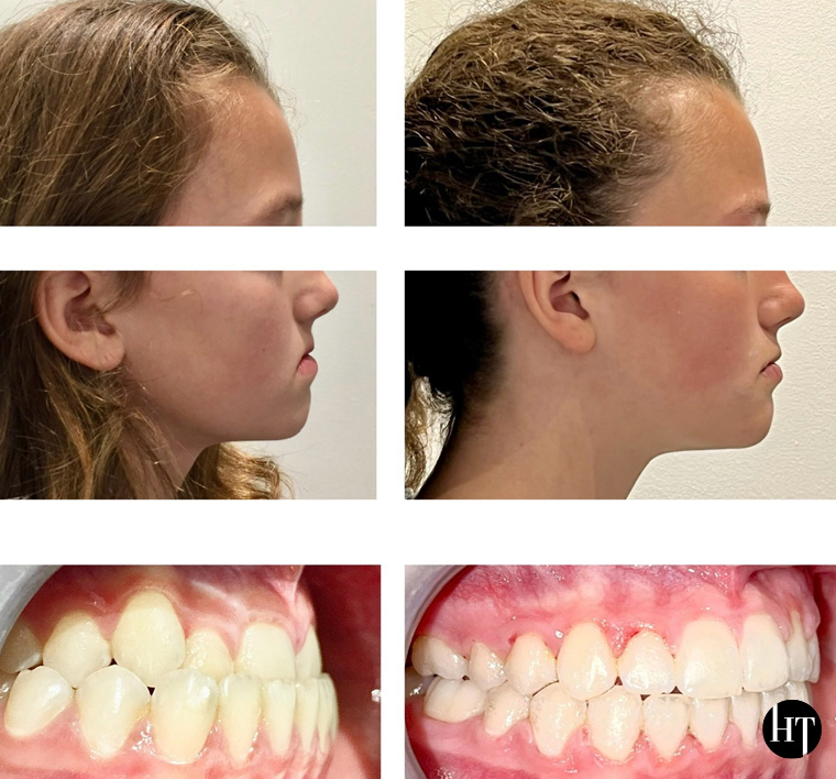 Traitement orthodontique adolescente de 12 ans