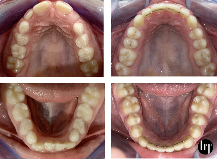 Traitement orthodontique adolescent de 9 ans Traitement orthodontique adolescent de 9 ans