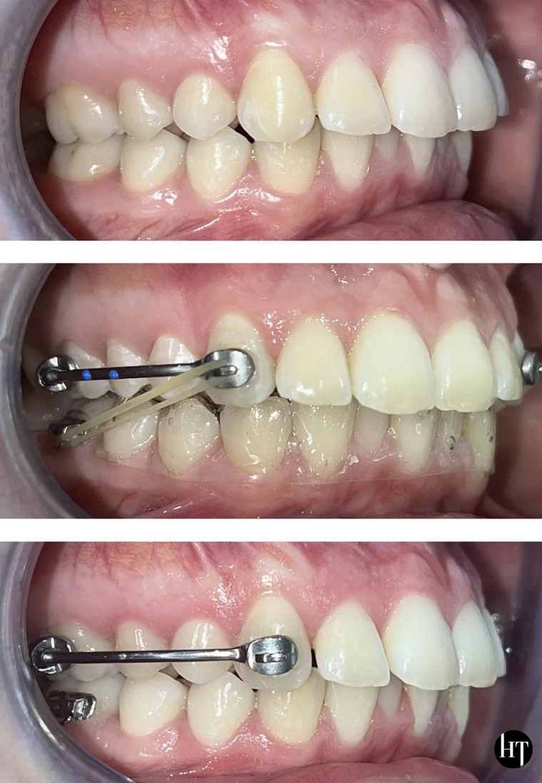 Traitement orthodontique adulte de 20 ans Traitement orthodontique adulte de 20 ans