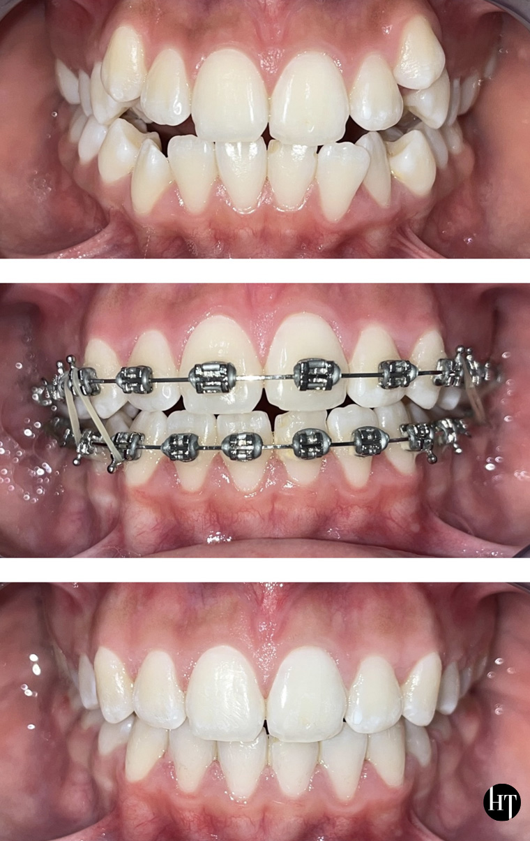 Traitement orthodontique adolescente de 14 ans Traitement orthodontique adolescente de 14 ans