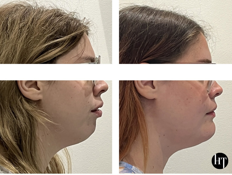 Traitement orthodontique adulte de 28 ans Traitement orthodontique adulte de 28 ans
