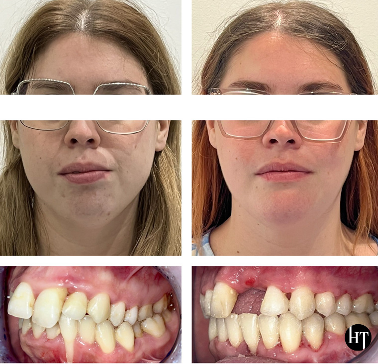 Traitement orthodontique adulte de 28 ans Traitement orthodontique adulte de 28 ans